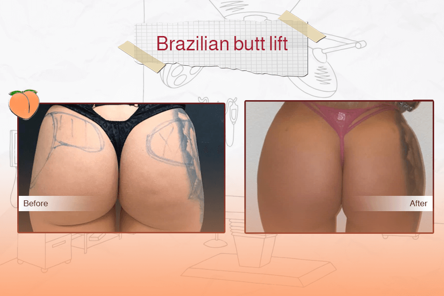 Brazilian Butt Lift