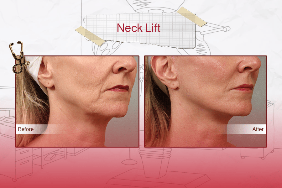 Neck lift