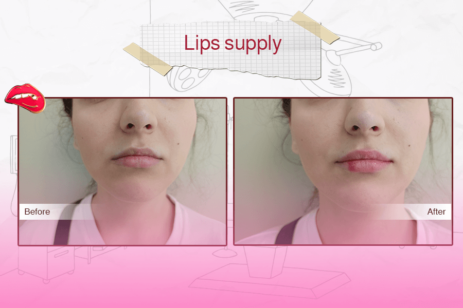 Lips Filler