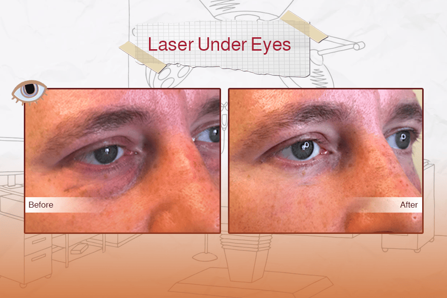 Laser Eyelid