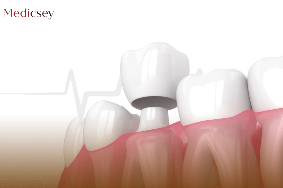 Dental Crowns