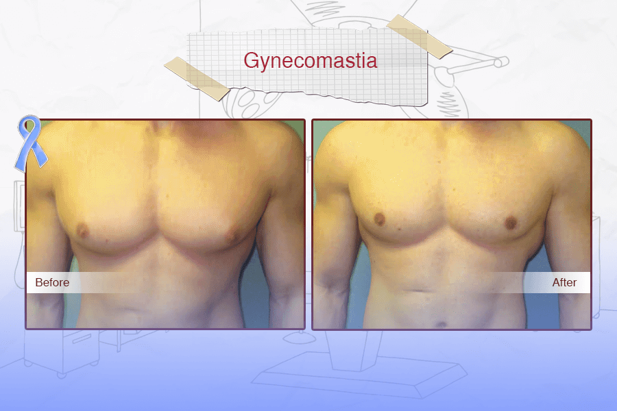 Gynecomastia