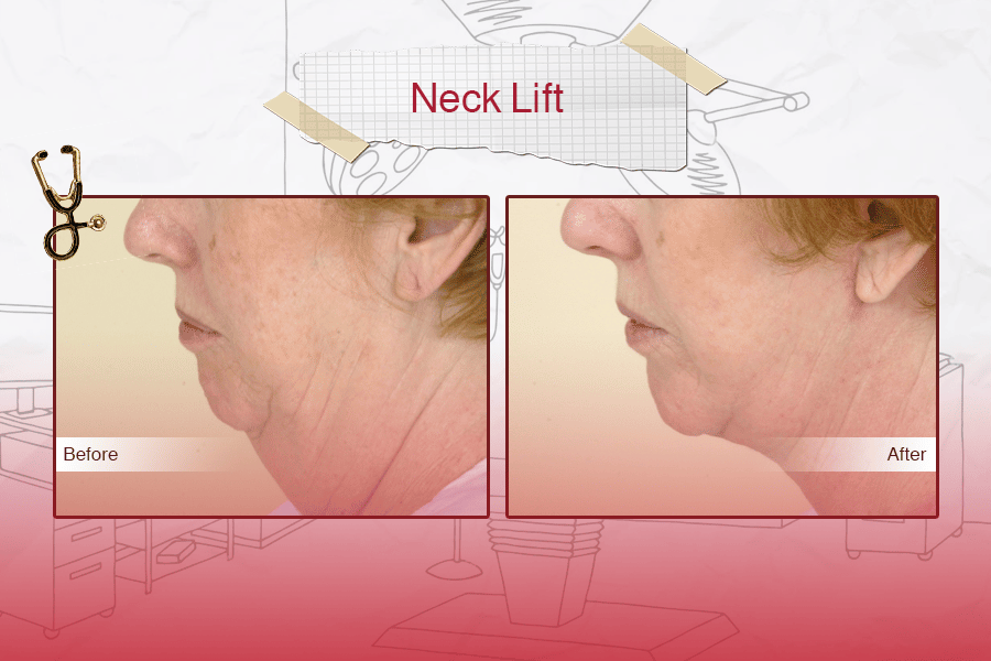 Neck lift