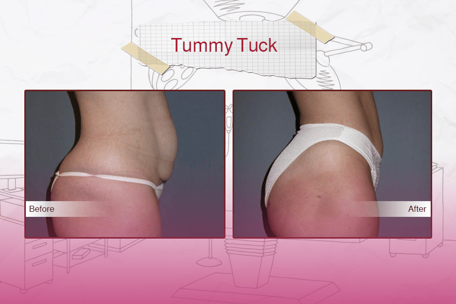 Tummy Tuck