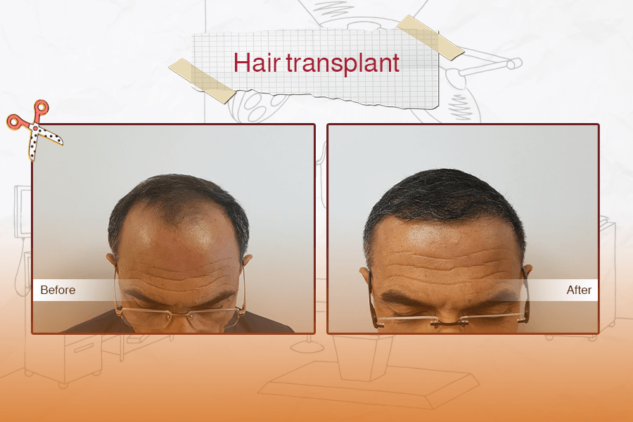 Hair Transplant