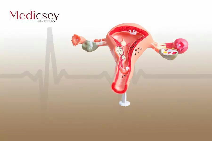 vulvar cancer treatment in Turkey