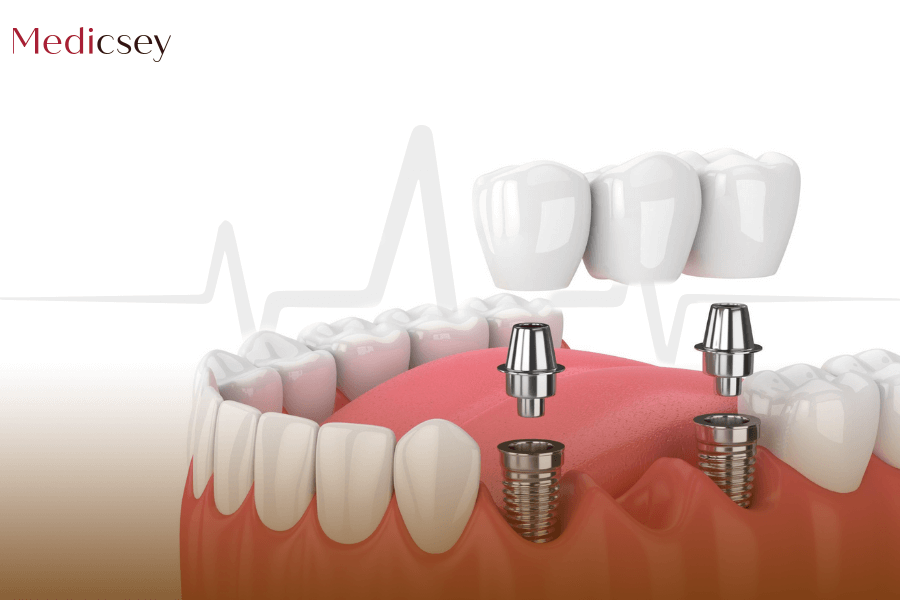  Implants dentaires