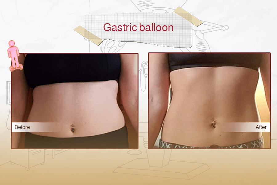 Gastric Balloon