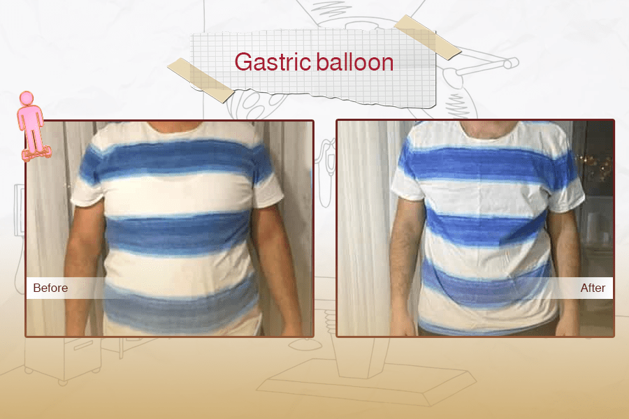 Gastric Balloon