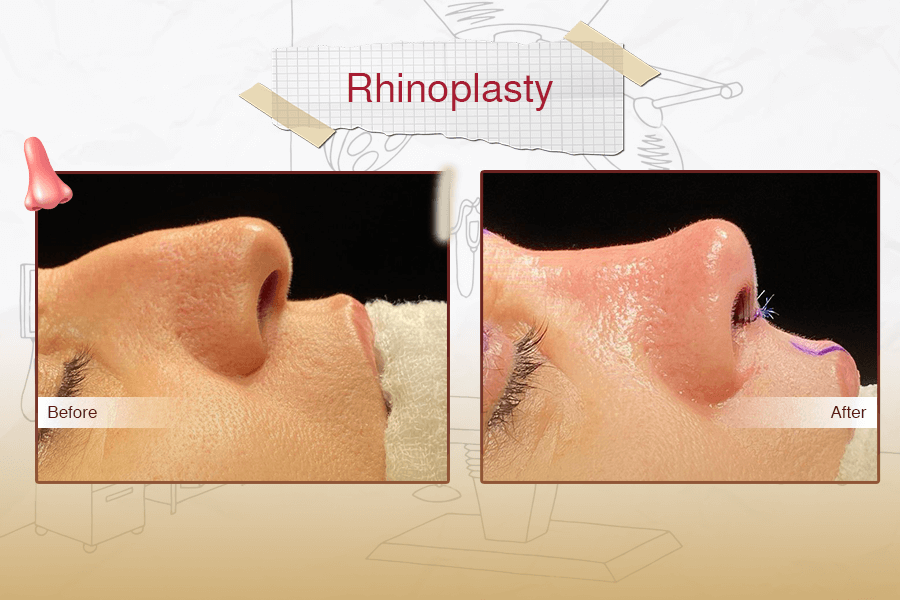 Rhinoplasty