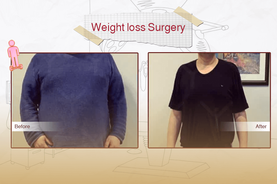 Weight Loss Surgery