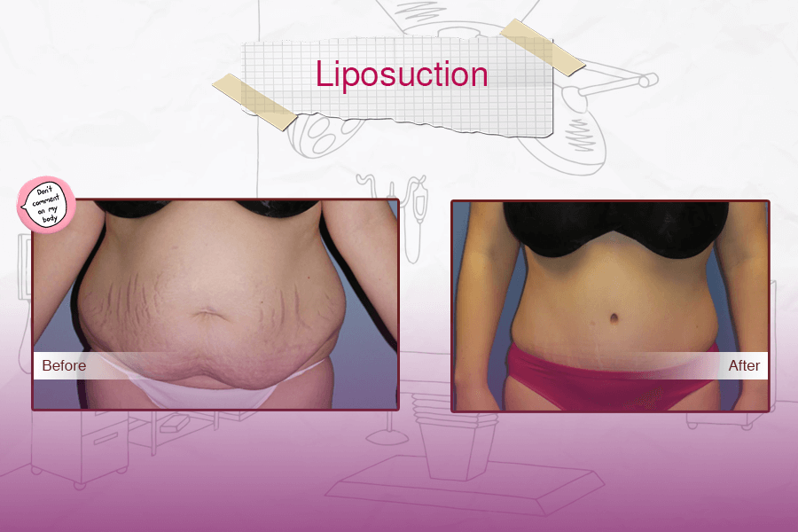 Liposuction