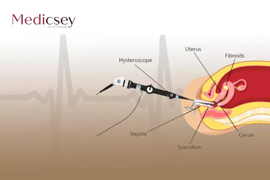 Laparoscopic Procedures