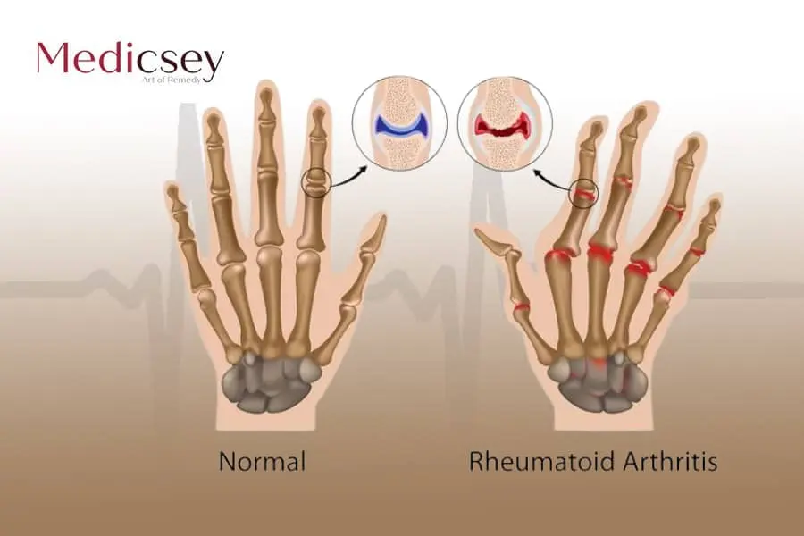 أسباب وعلاج التهاب المفاصل الروماتيدي في تركيا