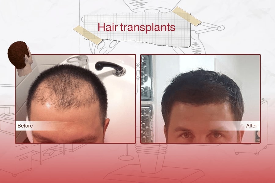 Hair Transplant