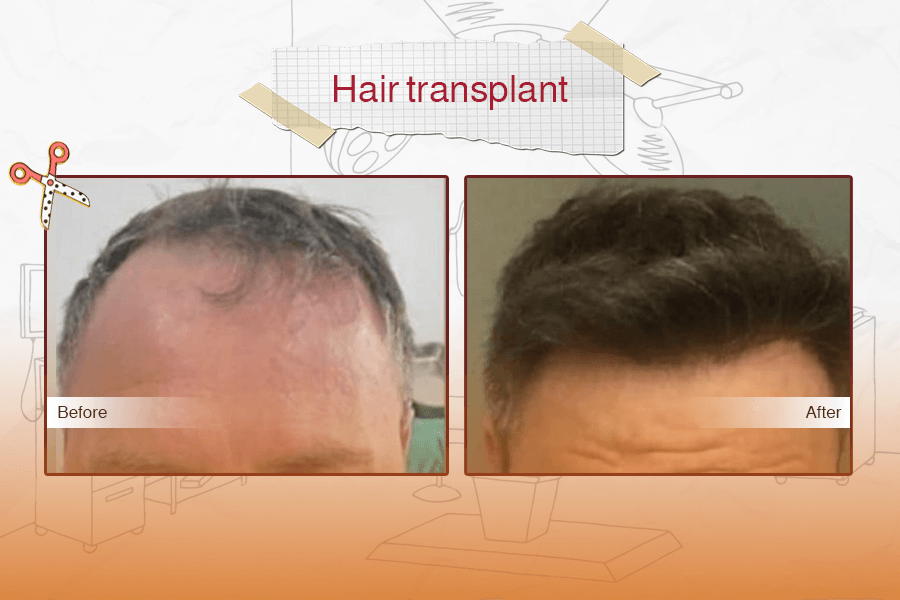 Hair Transplant