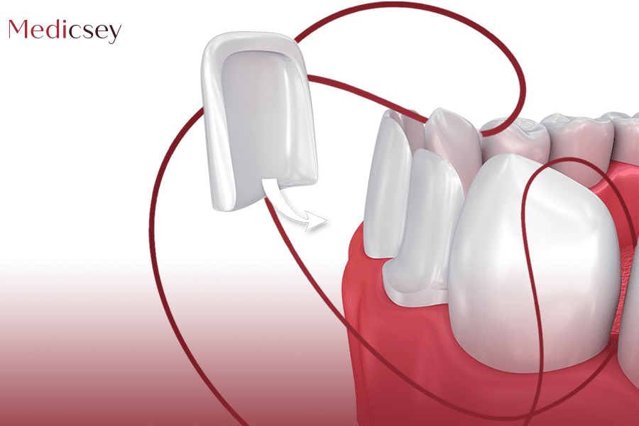 تركيب فينير الأسنان في اسطنبول