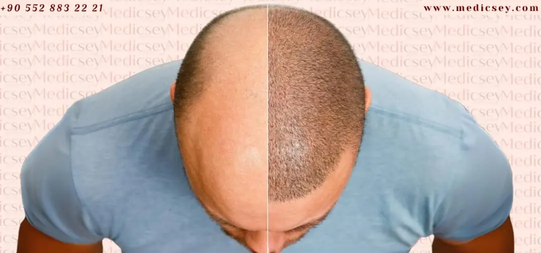 Best hair transplant center in Istanbul 2024