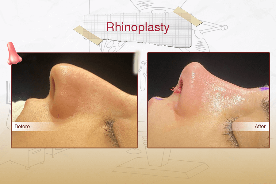 Rhinoplasty