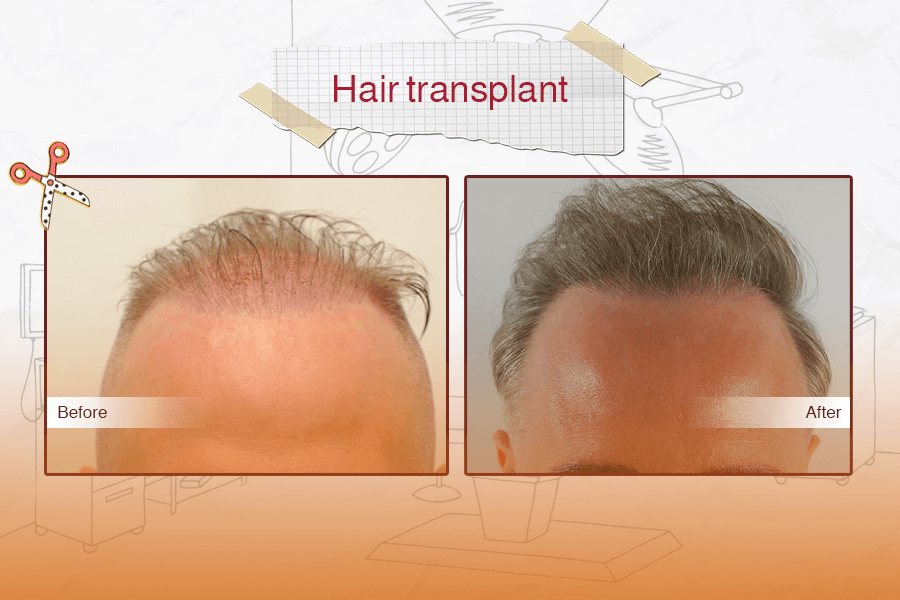 Hair Transplant