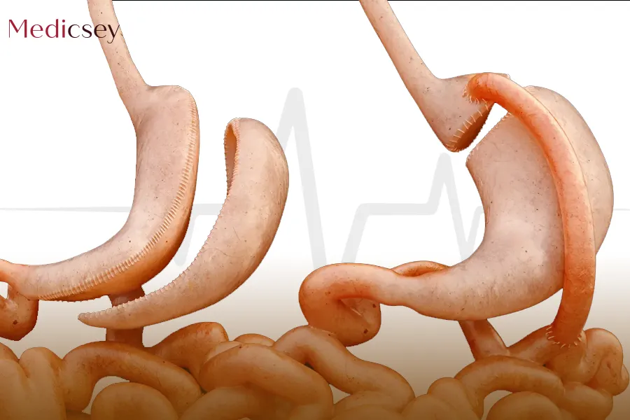 Sleeve Gastrectomy