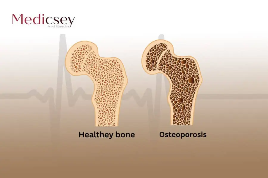 Osteoporosis in Turkey, its causes and treatment