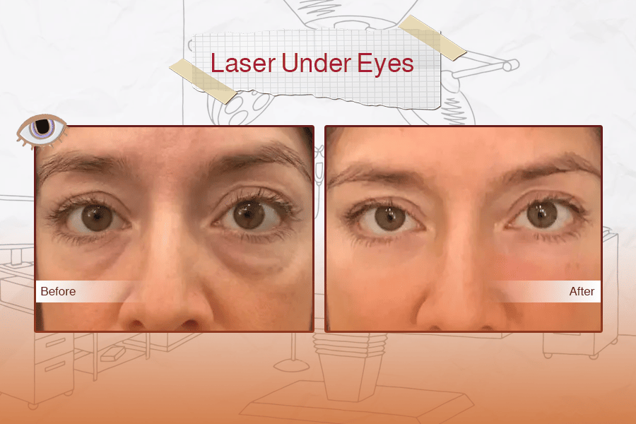 Laser Eyelid