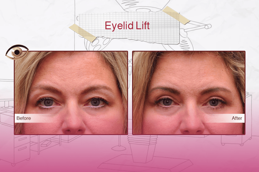 Blepharoplasty