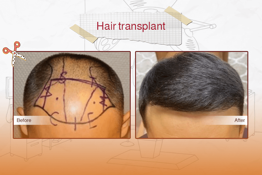 Hair Transplant