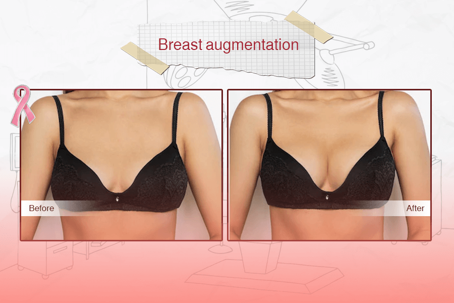 Breast Augmentation 