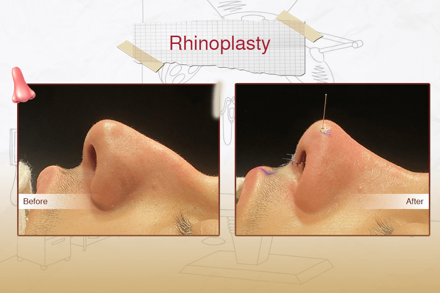 Rhinoplasty