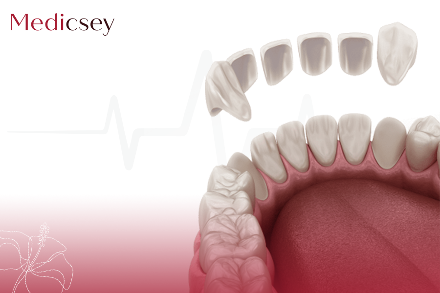 Porcelain Veneers