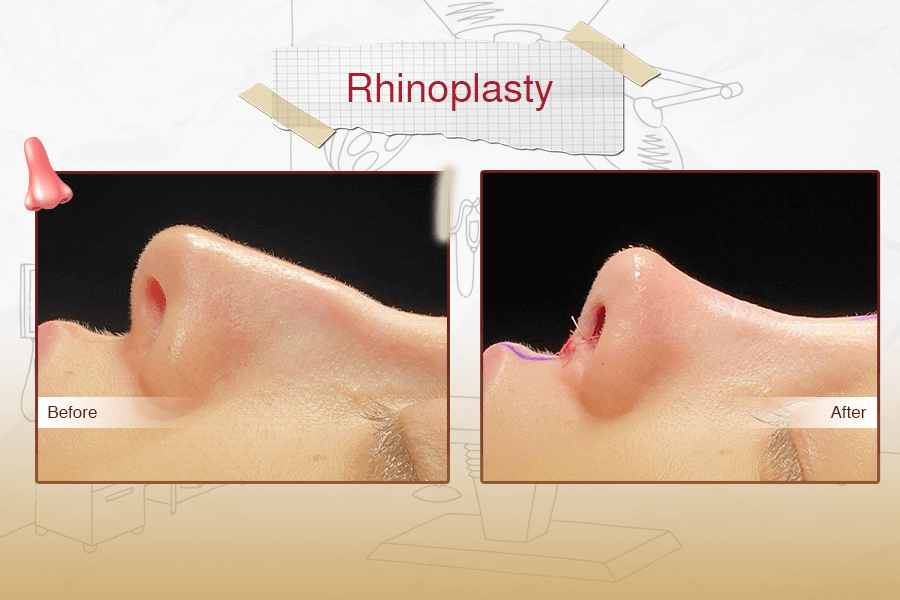 Rhinoplasty