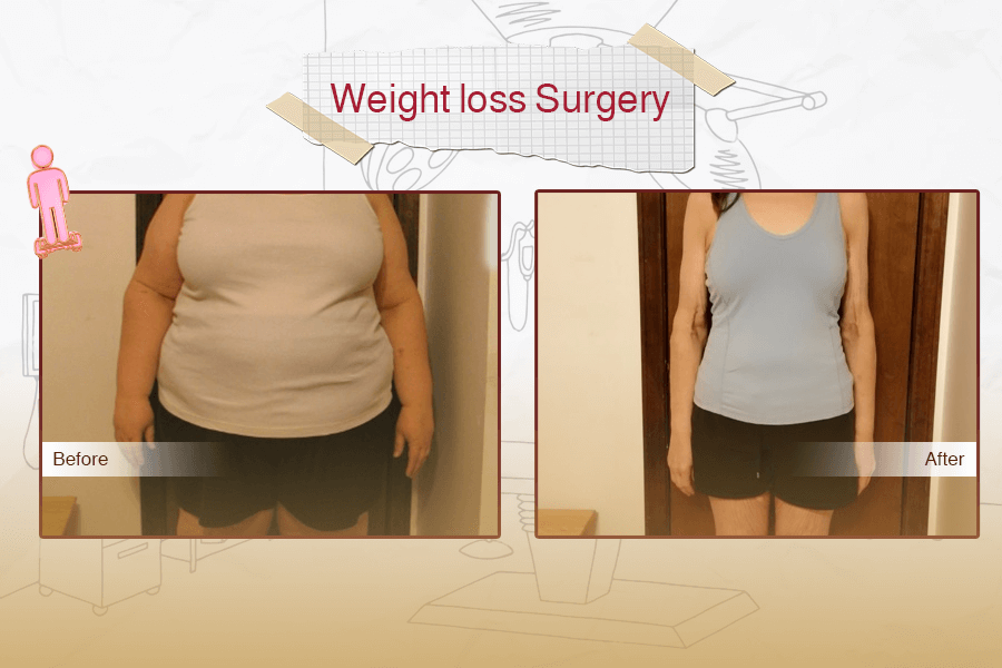 Weight Loss Surgery