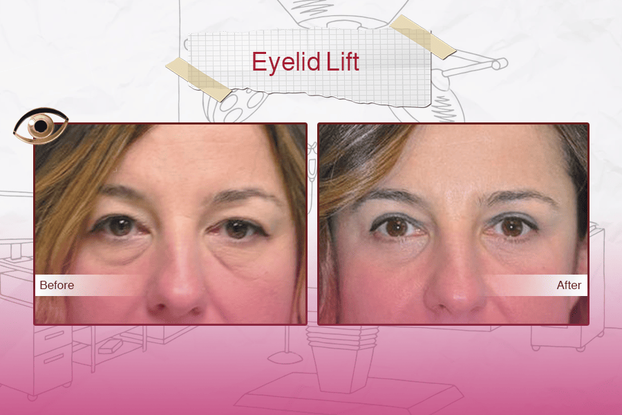 Blepharoplasty