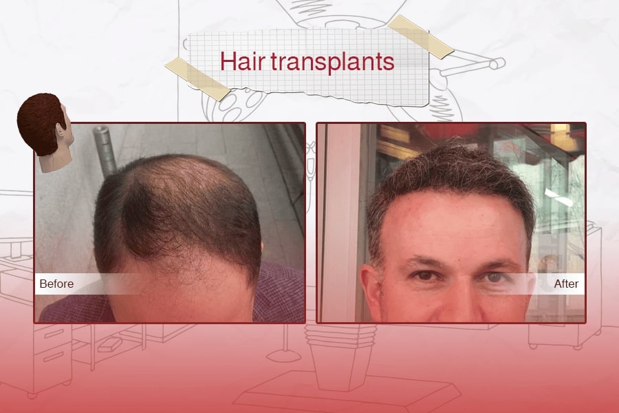 Hair Transplant