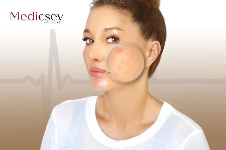 Acne scar treatment in Turkey 2024